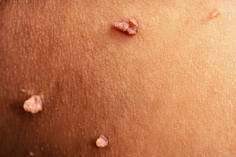 Are Skin Tags a Sign of Diabetes?