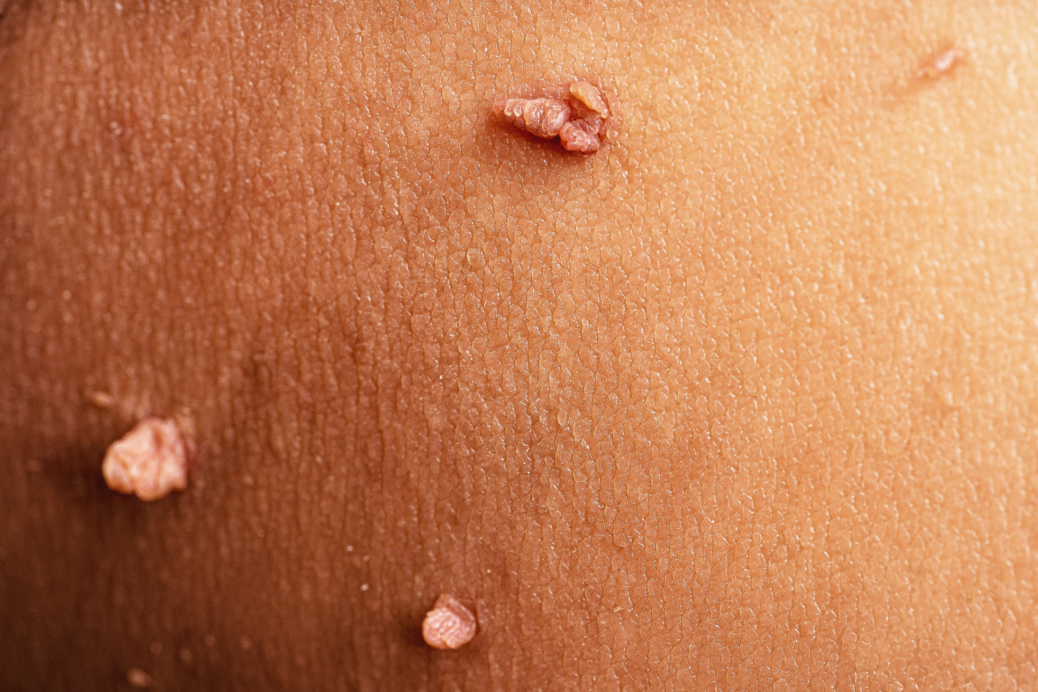 Are Skin Tags a Sign of Diabetes?
