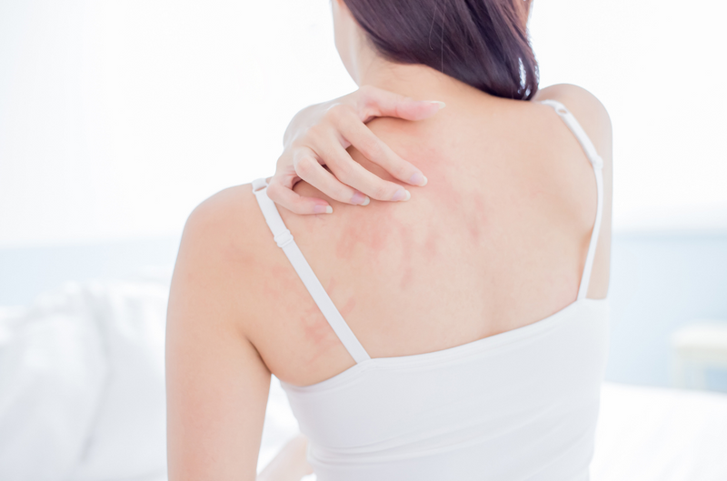 The Best Cream for Eczema