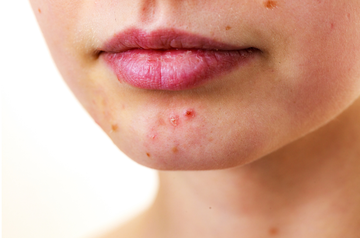 How Magnesium Can Make Your Acne Better