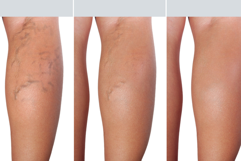 How to Use Magnesium for Varicose Veins