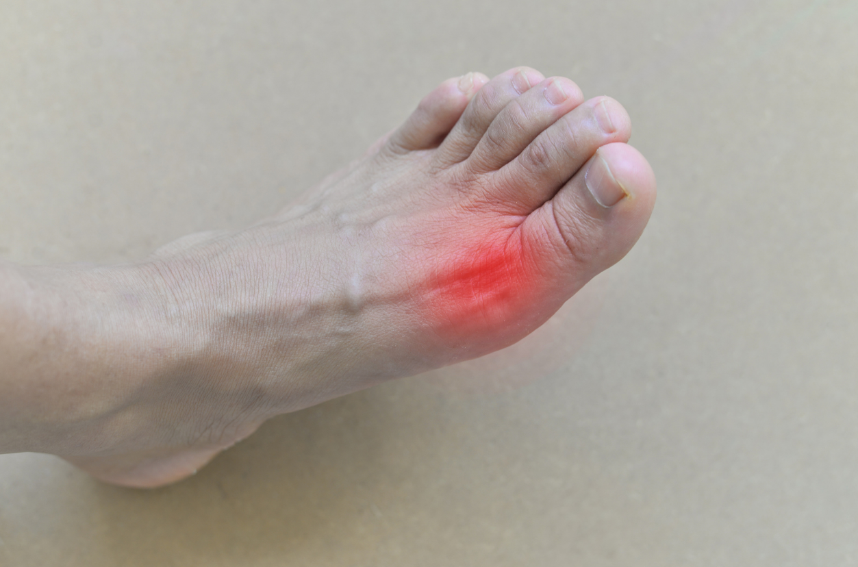 Is Epsom Salt Helpful for Gout?